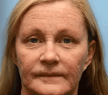 Rolimey® Bee Venom Skin Comprehensive Cream