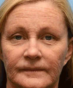 Rolimey® Botox-Lift Vita-A Retinol Shot Professional Anti-Aging Breakthrough (Made in AU ) 50 OFF - LAST 24 HOURS