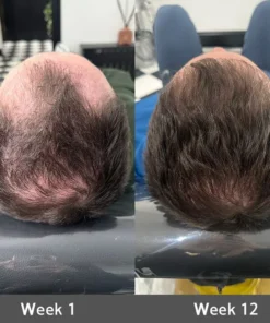 Rolimey® Highly Effective Biotin & Rosemary Hair Growth Serum