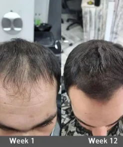 Rolimey® Highly Effective Biotin & Rosemary Hair Growth Serum