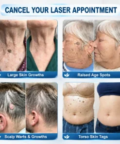 Rolimey® 7-Day Skin Tag & Blemish Remover Painless & Scar-Free – Advanced Mole & Wart Remover