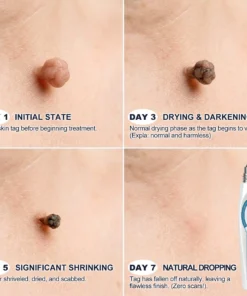 Rolimey® 7-Day Skin Tag & Blemish Remover Painless & Scar-Free – Advanced Mole & Wart Remover