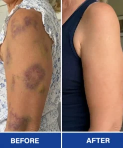Rolimey® BruiseRepair & Skin-Strengthening Cream