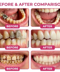 Rolimey® DenPerm Natural Enamel Restoration Gel