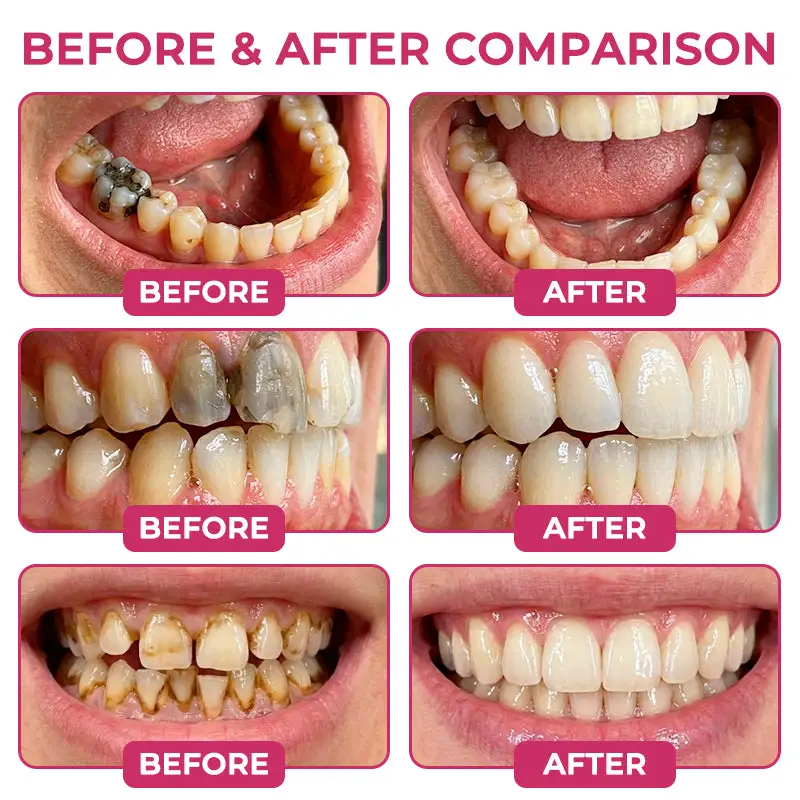 Rolimey® DenPerm Natural Enamel Restoration Gel