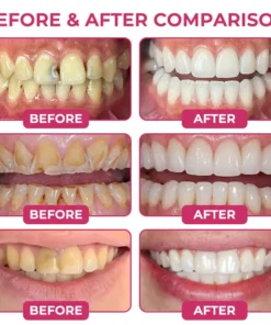 Rolimey® DenPerm Natural Enamel Restoration Gel
