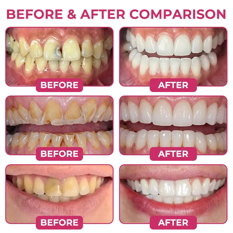 Rolimey® DenPerm Natural Enamel Restoration Gel