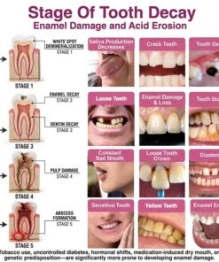 Rolimey® DenPerm Natural Enamel Restoration Gel